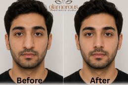 Before and After Rhinoplasty Result