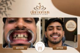 Before and After Root Canal Treatment