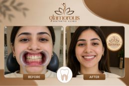 Before and After Root canal Result of Root canal treatment in Islamabad