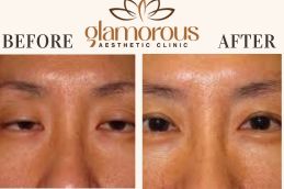 Before and After eyelid surgery in Islamabad Pakistan