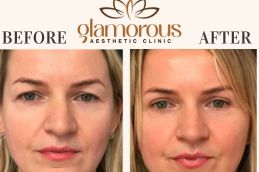 Before and After eyelid surgery in Islamabad Rawalpindi