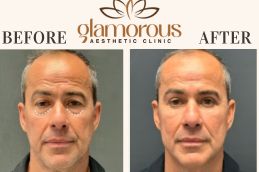 Before and After eyelid surgery in Islamabad Rawalpindi Pakistan