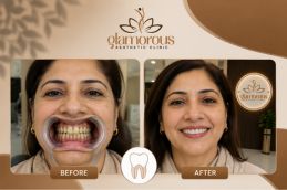 Before and After of Root canal in Islamabad