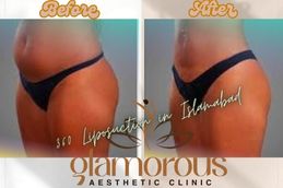 Before and After result 360 Liposuction in Islamabad