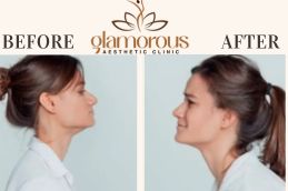Before and After result DoubleChin removal in Islamabad &Pakistan