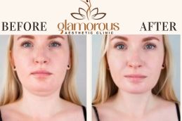 Before and After result DoubleChin removal in Islamabad , Rawalpindi &Pakistan