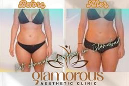 Before and After result fat reduction surgery