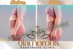 Before and After result fat reduction