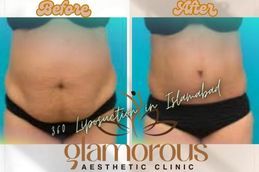 Before and After result of 360 Liposuction in Islamabad