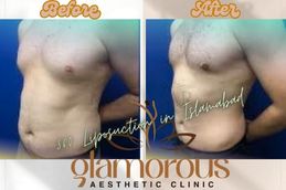 Before and After result of 360 Liposuction in Islamabad Pakistan
