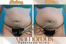 Before and After result of 360 Liposuction in Rawapindi & Islamabad Pakistan