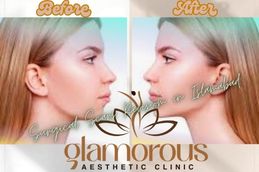 Before and After result of Jaw Surgery in Rawapindi & Islamabad