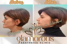 Before and After result of Jaw Surgery in Rawapindi Islamabad