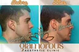 Before and After result of Jaw Surgery in Rawapindi Islamabad & Pakistan