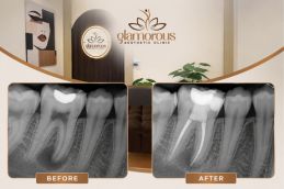 Before and After result of Root Canal