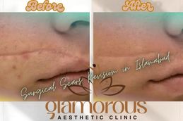 Before and After result of Surgical Scar Revision in Rawapindi Islamabad