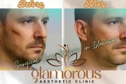 Before and After result of Surgical Scar Revision in Rawapindi Islamabad
