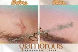 Before and After result of Surgical Scar Revision in Rawapindi Islamabad & Pakistan