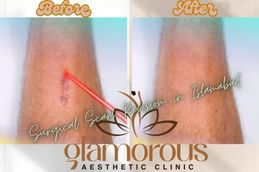 Before and After result of Surgicle scars Revision in Islamabad Pakistan