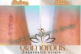 Before and After result of Surgicle scars Revision in Islamabad Pakistan