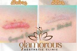 Before and After result of Surgicle scars Revision in Rawapindi & Islamabad