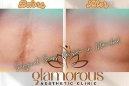 Before and After result of Surgiclescars Revision in Rawapindi & Islamabad Pakistan (1)