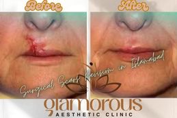 Before and After result of Surgiclescars Revision in Rawapindi & Islamabad Pakistan