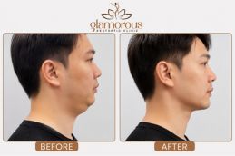 Before and After result of chin liposuction in Islamabad , Pakistan