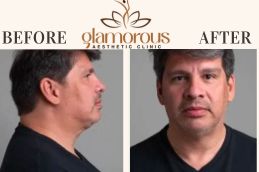 Before and After results DoubleChin removal in Islamabad & Pakistan