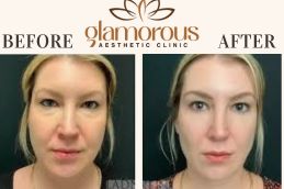 Before and After results eyelid in Islamabad Pakistan