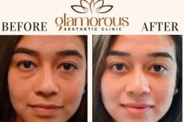 Before and After results eyelid in Islamabad