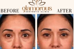 Before and After results eyelid surgery in Islamabad Pakistan