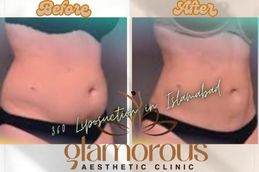 Before and After results of 360 Liposuction in Islamabad Pakistan
