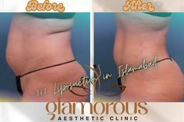 Before and After results of 360 Liposuction in Rawapindi & Islamabad Pakistan