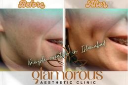 Before and After results of Dimple creation in Islamabad , Rawalpindi & Pakistan