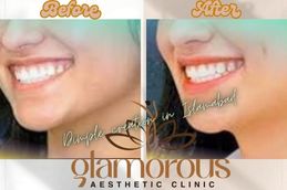 Before and After results of Dimple creation in Rawalpindi & Pakistan
