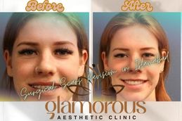 Before and After results of Jaw Surgery in Rawapindi & Islamabad
