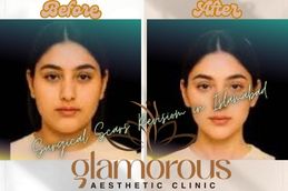 Before and After results of Jaw Surgery in Rawapindi Islamabad