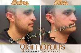 Before and After results of Jaw Surgery in Rawapindi & Islamabad Pakistan