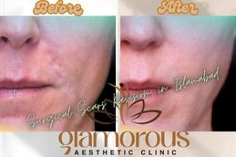 Before and After results of Surgical Scar Revision in Islamabad & Pakistan