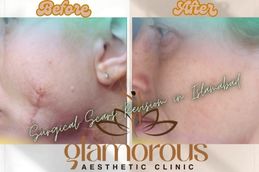 Before and After results of Surgical Scar Revision in Rawapindi Islamabad