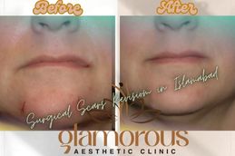Before and After results of Surgical Scar Revision in Rawapindi Islamabad & Pakistan