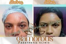 Before and After results of Surgiclescars Revision in Rawapindi & Islamabad Pakistan