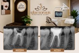 Before and After root canal treatment In Islamabad