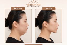 Chin Liposuction Result in Islamabad