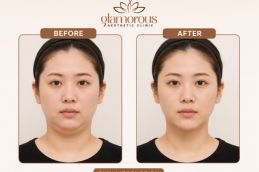 Chin Liposuction Results