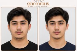 Chin Liposuction of chin Liposuction in Islamabad Pakistan