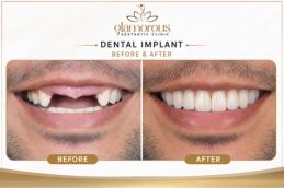 Dental implant in Islamabad