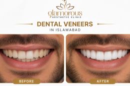 Dental veneers in In Islamabda