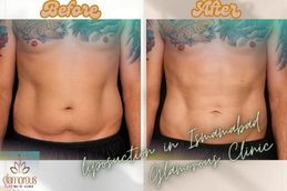 Liposuction in Islamabad Rawalpindi before and After Result